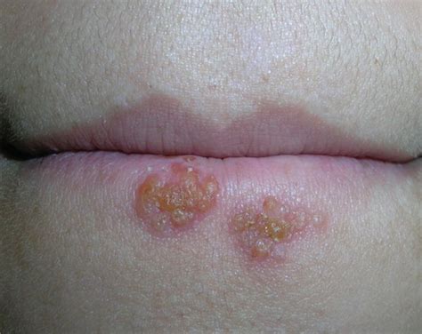 Cold Sore Stages (with Pictures) - The 5 Stages of Cold Sore Outbreak ...