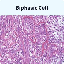 Mesothelioma Cells: The Three Major Mesothelioma Cell Types