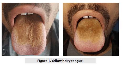 Yellow Coated Tongue Treatment