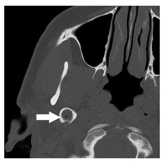 (a) Axial CT shows soft tissue attenuation material filling an expanded... | Download Scientific ...