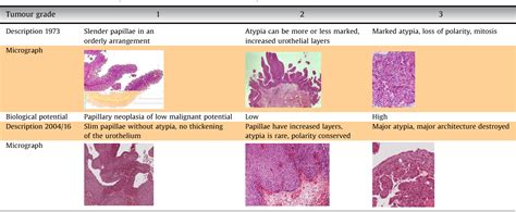 Table 1 from Grading of Urothelial Carcinoma and The New "World Health Organisation ...