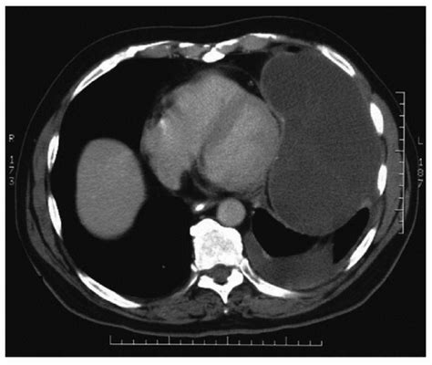 Pericardial Cyst | Thoracic Key