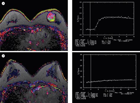 MRI-based perfusion map in breast cancer. (a) High perfusion indicated ...