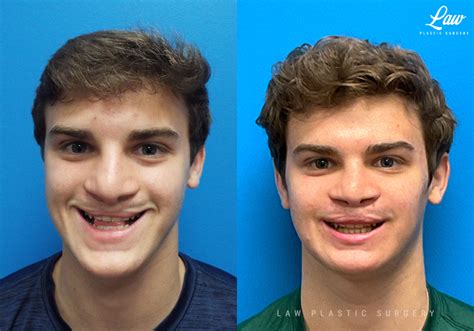 Jaw Surgery Before & After Photos - Sage Plastic Surgery