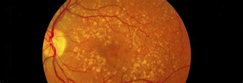 New research on dry age-related macular degeneration (AMD)