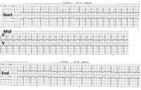 ECG Rhythms: AT Will Look Like ST