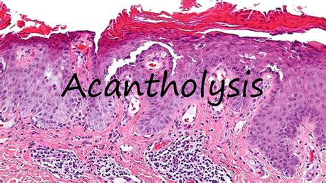 How to Pronounce Acantholysis? - YouTube