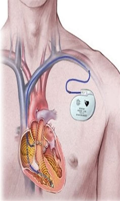 Amazon.com: About of Pacemaker Surgery: Appstore for Android