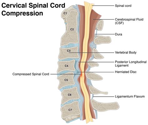 Cervical Spinal Cord Compression | Norelle Health