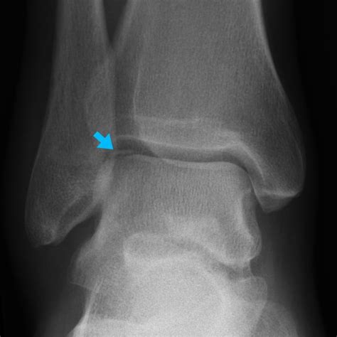 Osteochondral fracture of the talar dome | Radiology Case | Radiopaedia ...