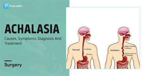 Achalasia: Causes, Symptoms, Diagnosis and Treatment