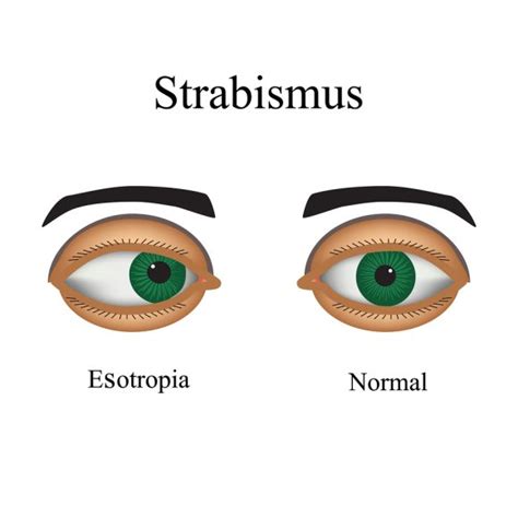 Strabismus | Chicago | Gerstein Eye Institute