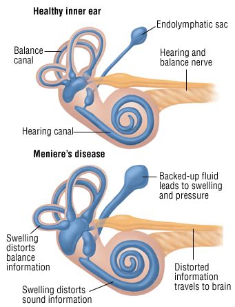 Meniere's Disease - The Hearing Doctor