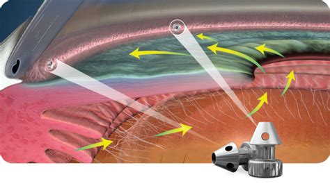 Minimally Invasive Glaucoma Surgery (MIGS) - Azar Eye Clinic