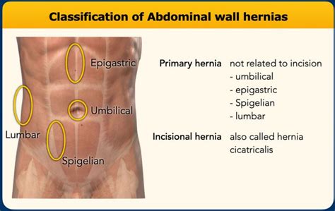 The Radiology Assistant : Abdominal wall hernias