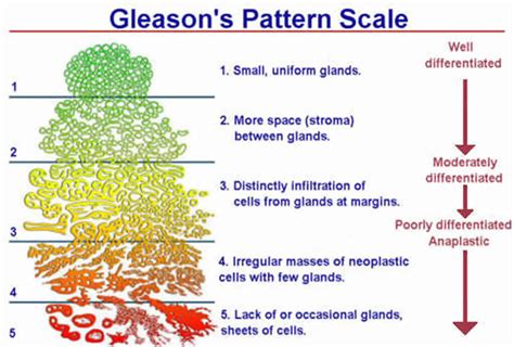 What is the Gleason Score? | KOELIS