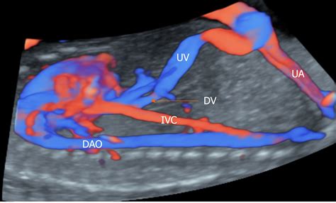 Correlation between ductus venosus spectrum and right ventricular diastolic function in isolated ...