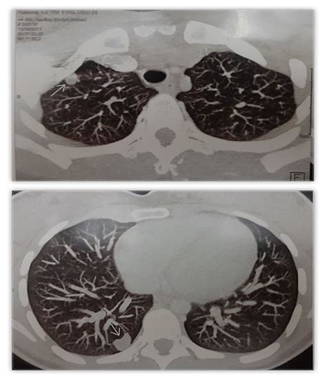 Chest CT scan with contrast, showing two metastatic nodules in the lung ...