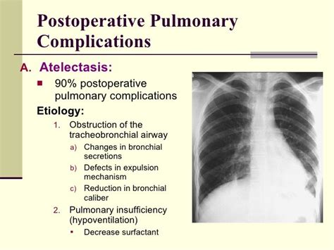 Surgical Complications