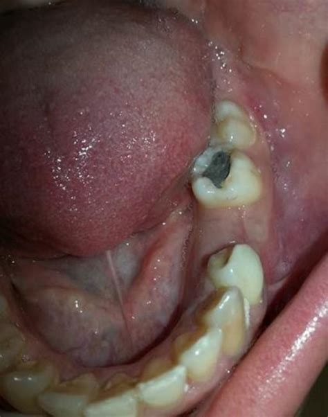 Intra-oral view showing the swelling with expansion of buccal and... | Download Scientific Diagram