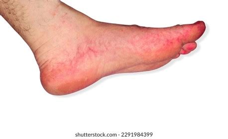 Secondary Syphilis Rash On Man Feet Stock Photo 2291984399 | Shutterstock