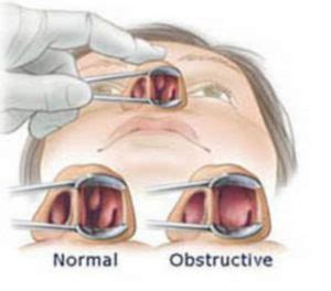 Swollen Turbinates Treatment in Encino or West Hills, California ...