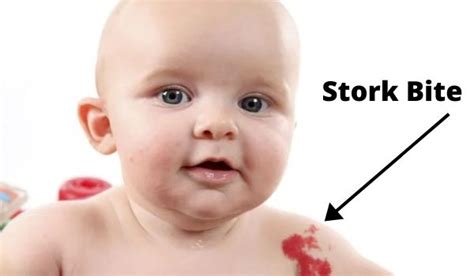 Stork Bite vs Hemangioma - Baby Rashes