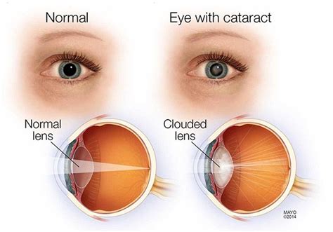 Cataracts | Hummel Eye Associates | Oklahoma City, Oklahoma