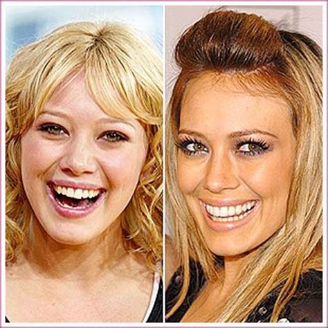 Hilary Duff before and after surgery #BotoxTips | Celebrity plastic ...