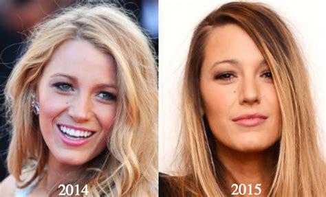 Blake Lively Plastic Surgery Before and After Photos