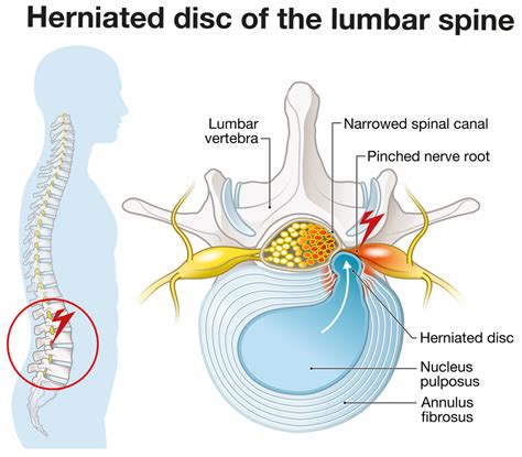 Treatment for Herniated Disc | Premia Spine Blog