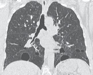 year-old woman with Birt-Hogg-Dubé syndrome. Coronal reformatted image... | Download Scientific ...