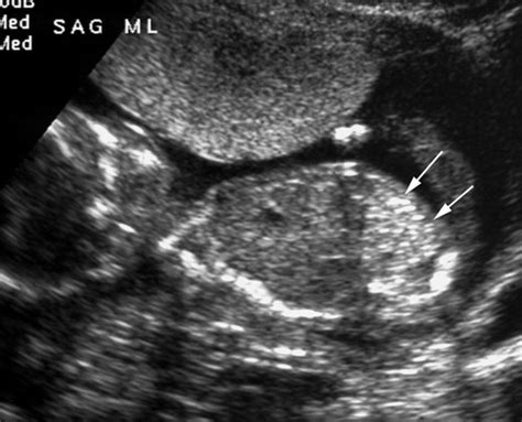 Echogenic Ultrasound