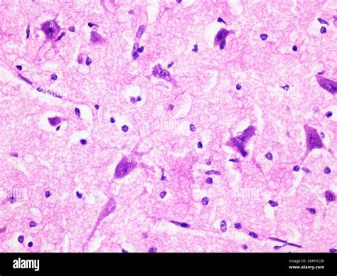 Histology of Human Brain Tissue Viewed at 400x Magnification with Haematoxylin and Eosin ...