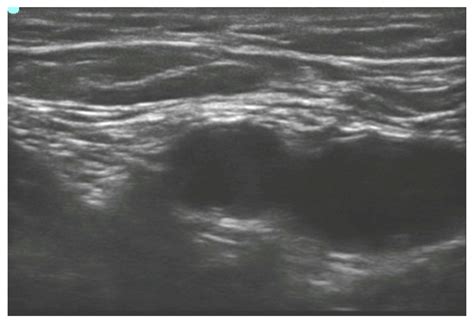 Ultrasound Guided Femoral Nerve Block : WFSA - Resources