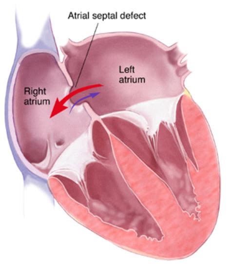 Dokter Eva: Dampak Kolesterol - Defek Septum Atrial (Atrial Septal Defect)