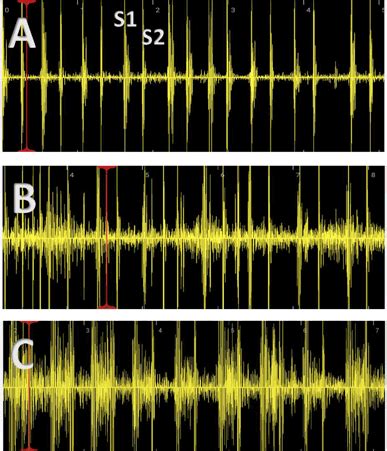 A typical phonocardiogram for a normal cardiac exam without murmur, b ...