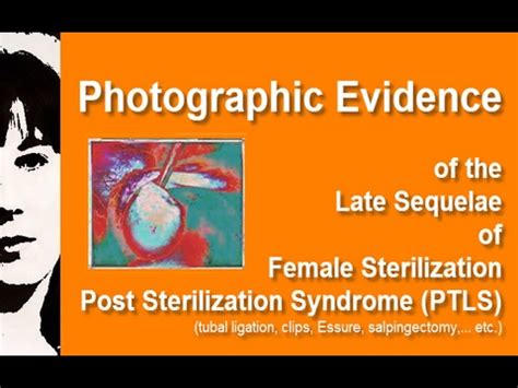 Exposing the side effects of female sterilization (tubal ligation ...