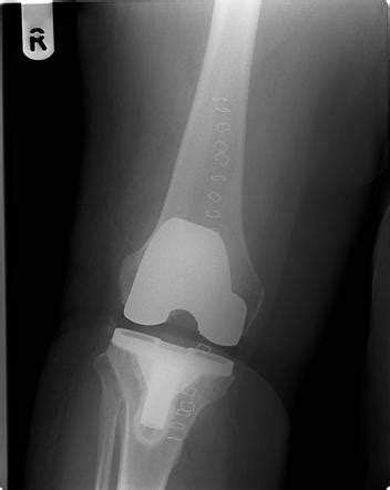 Knee Replacement Xray