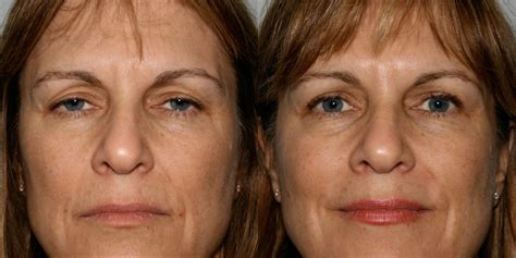 BEFORE AFTER BLEPHAROPLASTY SURGERY - before after