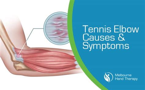 Tennis Elbow: Causes, Symptoms, and Treatment