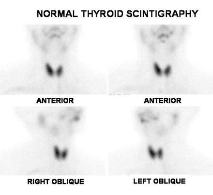 NORMAL THYROID SCINTIGRAPHY