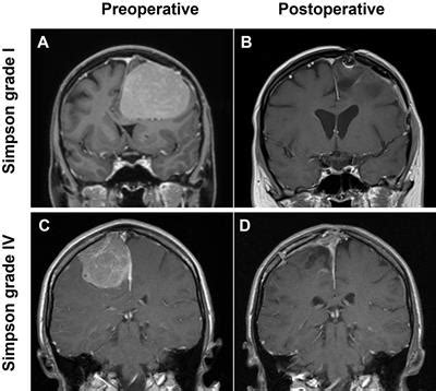 Frontiers | Symptom burden and surgical outcome in non-skull base ...