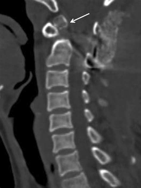 Posterior C1–C2 atlanto-axial fusion was performed and postoperative CT... | Download Scientific ...