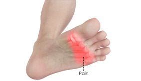 Metatarsal Surgery | Mark A Vann, MD Orthopaedic Surgeon Trauma, Foot & Ankle Reconstruction ...