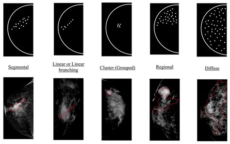 Diagnostics | Free Full-Text | End-to-End Calcification Distribution Pattern Recognition for ...