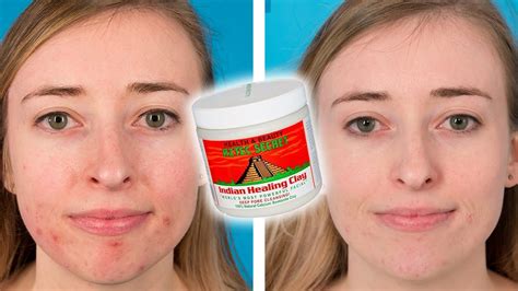 People Try The Aztec Healing Clay Face Mask For Their Acne - YouTube