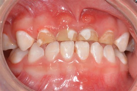 Early Childhood Caries Symptoms: White Spot Lesions, Tooth Decay, Pain, Swelling, Eating or ...