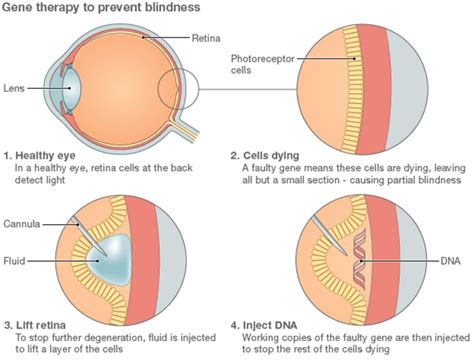 Gene therapy 'could be used to treat blindness' - BBC News