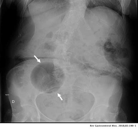 Diverticulitis with a giant colonic diverticulum | Revista de Gastroenterología de México